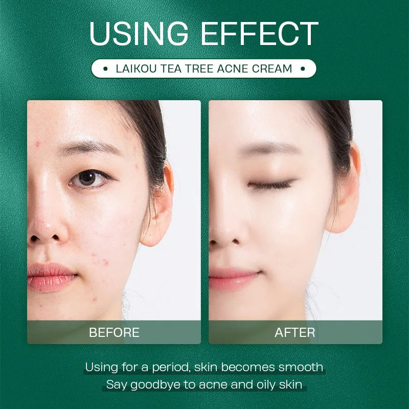 LAIKOU Tea Tree Acne Cream Effective Acne Removal Cream Acne Treatment Shrink Pores Moisturizing Brightening Face Skin Care