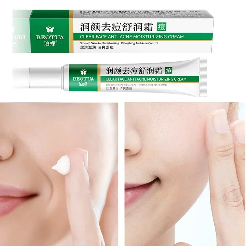 c Herbal Acne Removal Cream Whitening Moisturizing Shrink Pores Oil Control Pimples Acne Treatment Gel Skin Care Face Cream