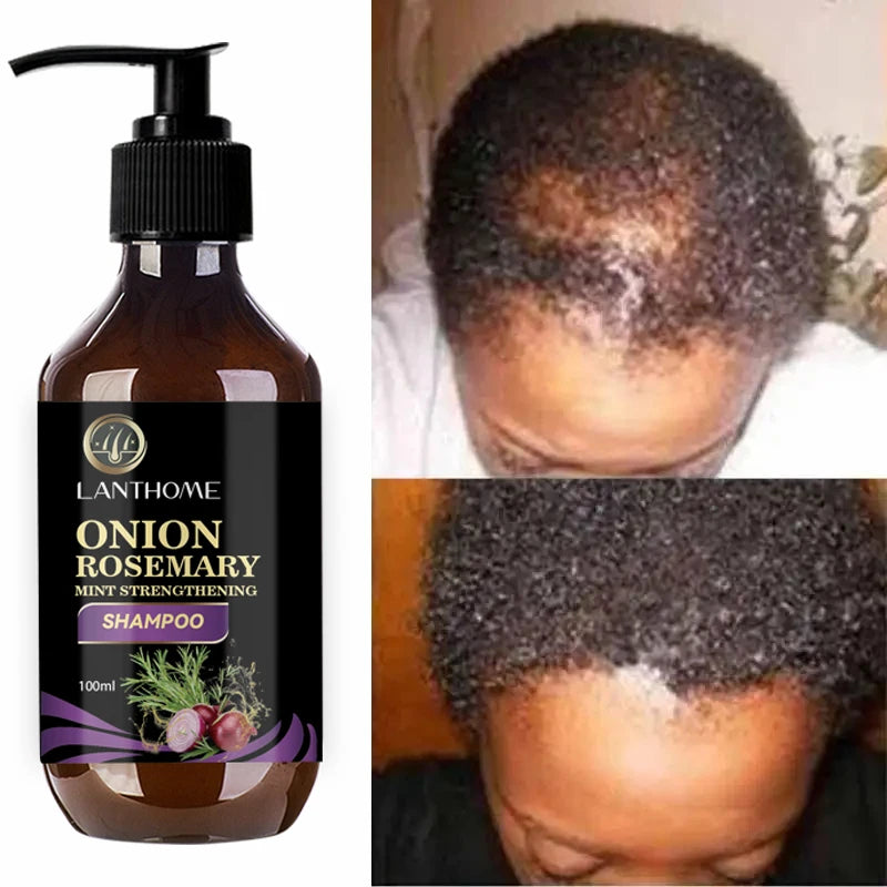 Hair Shampoo For Fast Hair Growth Rosemary Onion Hair Anti Hair Loss For Women