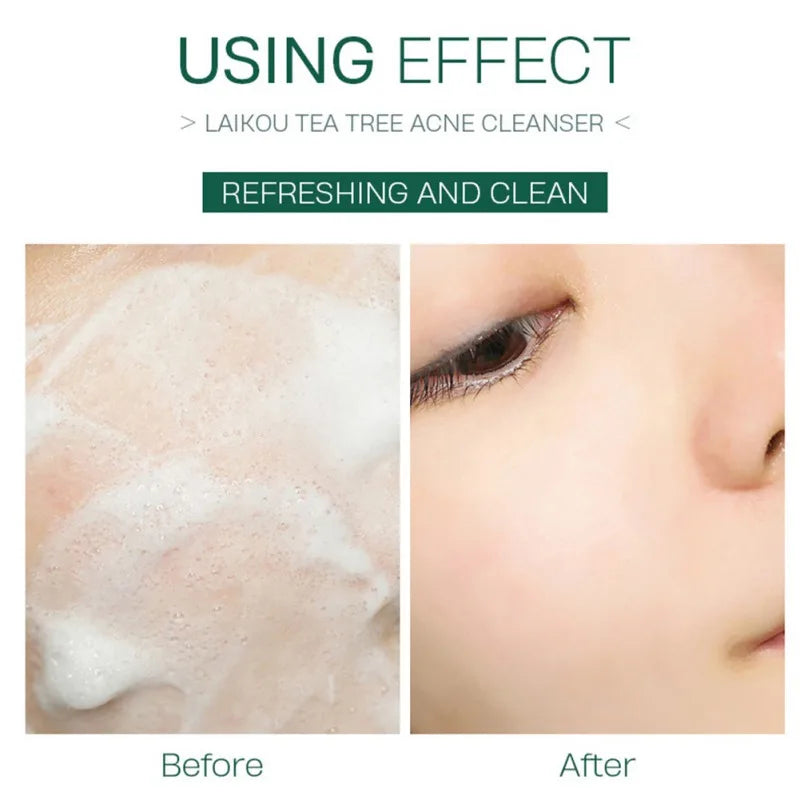 Pores Tightening Tea Tree  Oil for Acne Scars Gentle Foam  Facial Cleanser