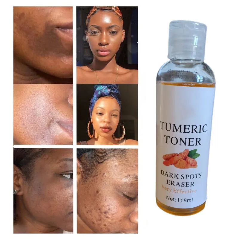 Turmeric Dark Spots and Acne Facial  Toner