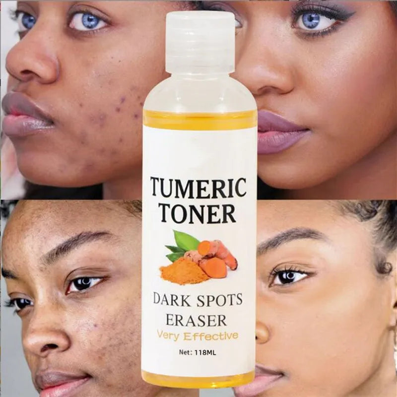 Turmeric Dark Spots and Acne Facial  Toner